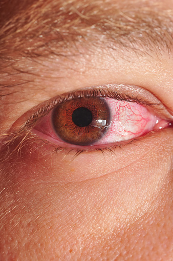 Marco shot of a man's eye suffering from conjunctivitis also known as pink eye.