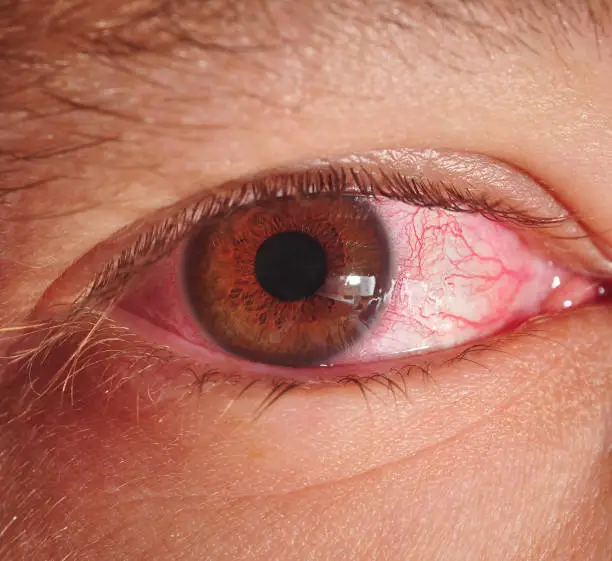 Marco shot of a man's eye suffering from conjunctivitis also known as pink eye.
