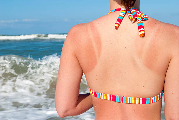 quemaduras de sol mujer en la playa - quemado por el sol fotografías e imágenes de stock