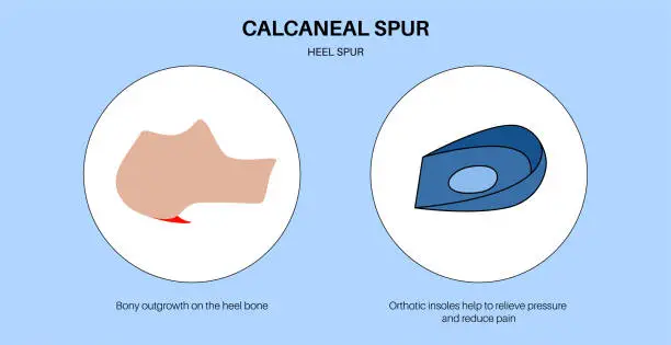 Vector illustration of Orthotic shoe and insoles