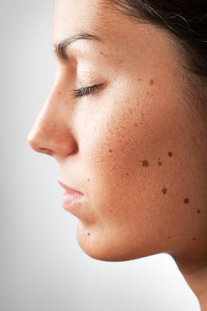 Portrait of a Woman with Melanoma Moles and Freckles (XXXL) Portrait of a Woman with Melanoma Moles and Freckles. Selective focus on the cheek. Nikon D3X. Converted from RAW (XXXL) mole stock pictures, royalty-free photos & images