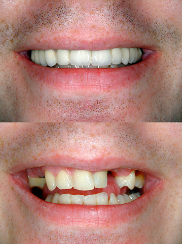 Before and after Smile design dental procedure photos . Selective soft focus.