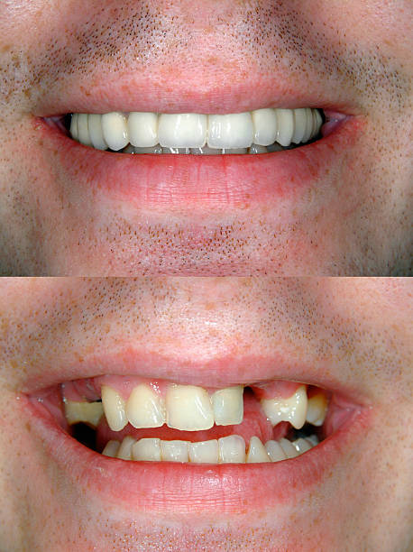 Before & After Smile Design stock photo