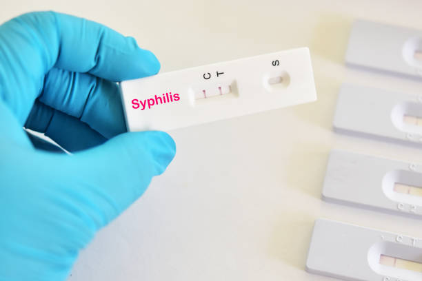 Syphilis positive stock photo