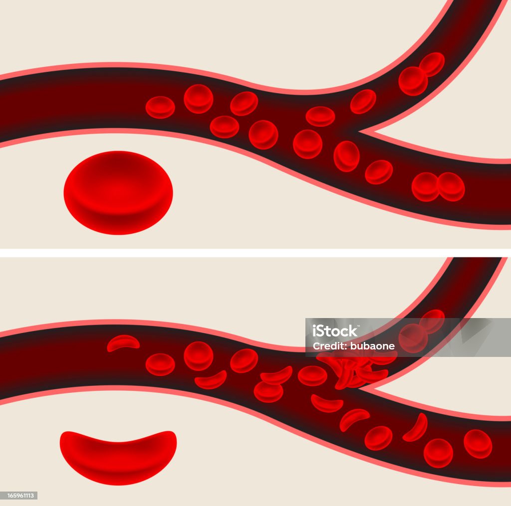 Cellule del sangue umano e Talassemia il flusso del sangue dalle vene - arte vettoriale royalty-free di Anemia a cellule falciformi