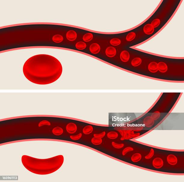 Cellule Del Sangue Umano E Talassemia Il Flusso Del Sangue Dalle Vene - Immagini vettoriali stock e altre immagini di Anemia a cellule falciformi