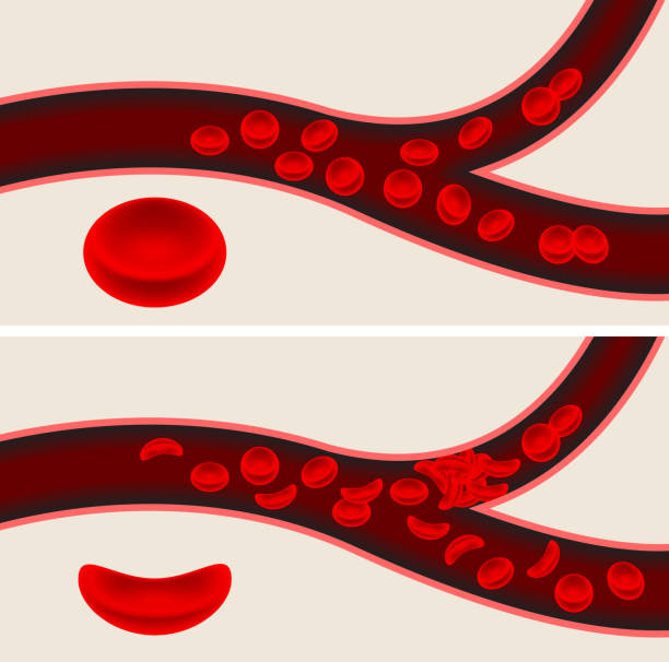 human blood cells and sickle cell anemia blood flow veins human blood cells and Sickle Cell blood flow through veins. this horizontal split image features two medical illustrations indicating human veins and blood flow. The cells in the first medical diagram are normal. The cells in the second medical diagram show sickle cell anemia  blood vessel stock illustrations