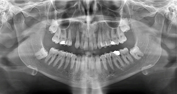 X-ray of the human mouth showing dental