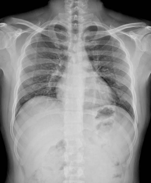 istock Analysing an x ray of a patient’s lung 1659841181