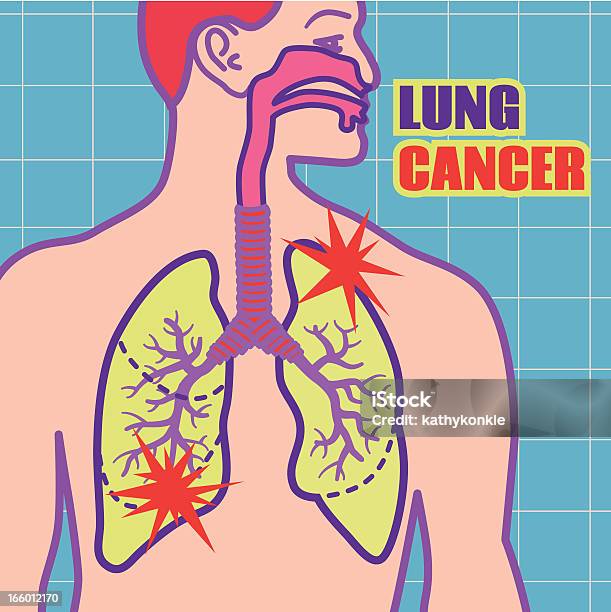 Ilustración de Cáncer De Pulmón y más Vectores Libres de Derechos de Vector - Vector, Adulto, Asistencia sanitaria y medicina