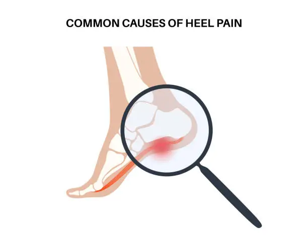 Vector illustration of Pain of the heel