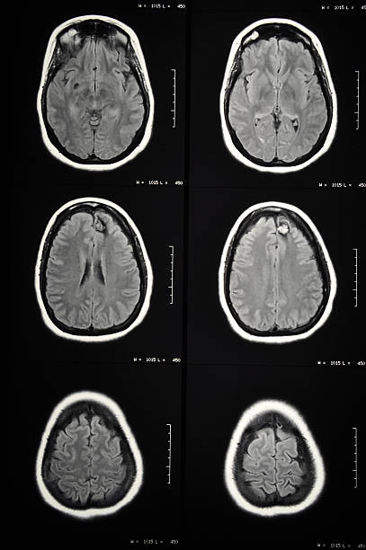vascular malformation im gehirn (cavernoma) - epilepsy healthcare and medicine surgery sulcus stock-fotos und bilder