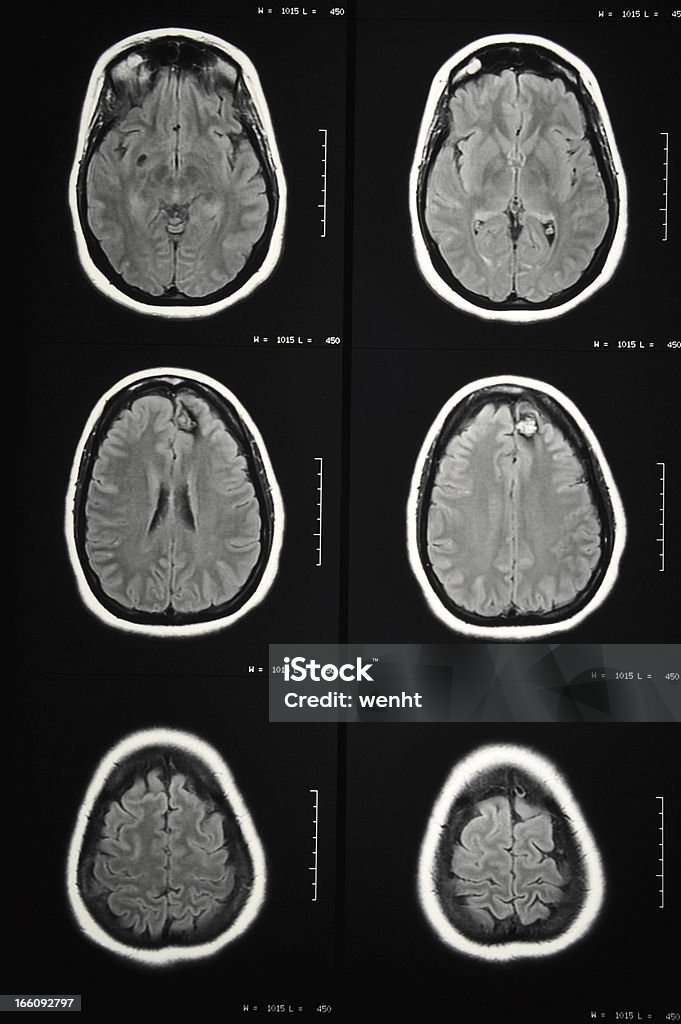 Malformazione vascolare nel cervello (cavernoma) - Foto stock royalty-free di Cerebrum