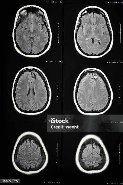 Foto de Terapia Malformation No Cérebro e mais fotos de stock de Cirurgia - Cirurgia, Cirurgia Cerebral, Convulsão