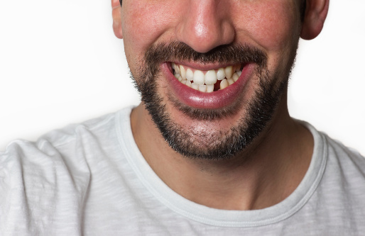 Hombre faltante dientes photo