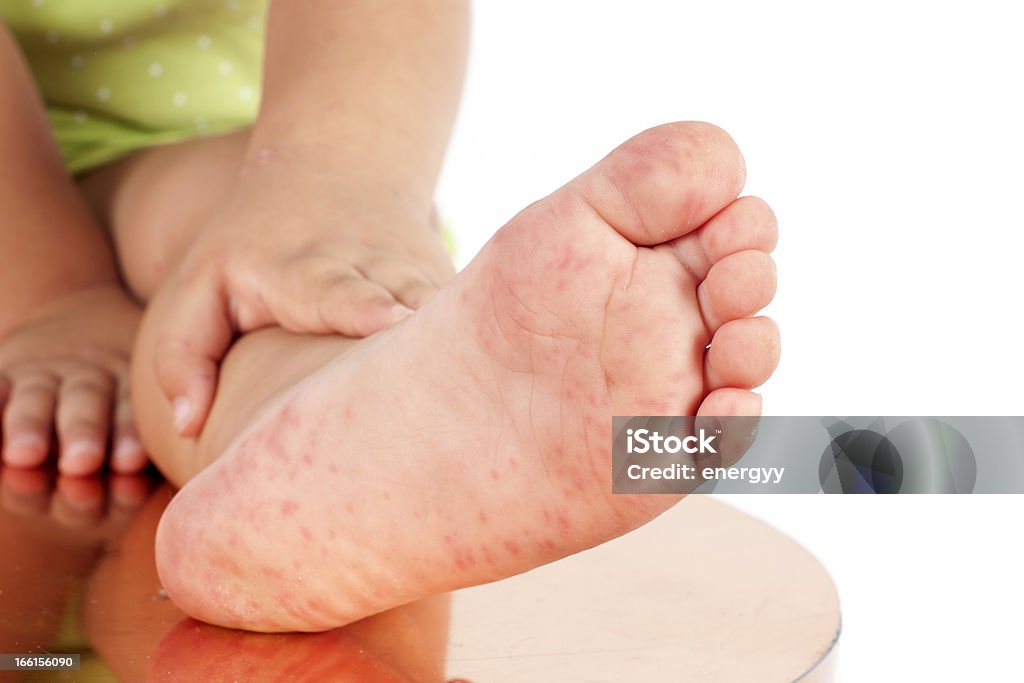 Folliculitis On Child's Foot Child Stock Photo