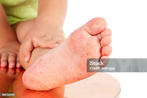 Folliculitis On Childs Foot Stock Photo - Download Image Now - Child, Illness, Hives - Skin Condition