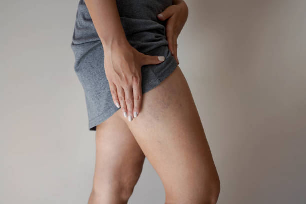 Painful varicose veins on woman legs Painful varicose veins on woman legs varicose vein stock pictures, royalty-free photos & images