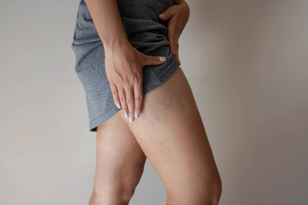 болезненное варикозное расширение вен на ногах женщины - человеческая нога стоковые фото и изображения