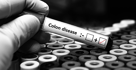 Blood sample of patient positive tested for colon disease.