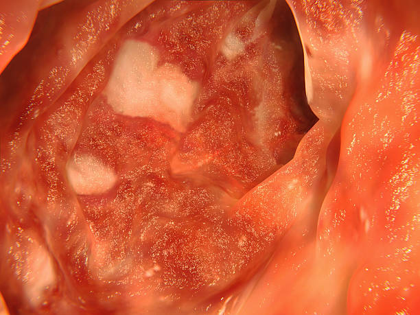 Colon affected by ulcerative colitis stock photo