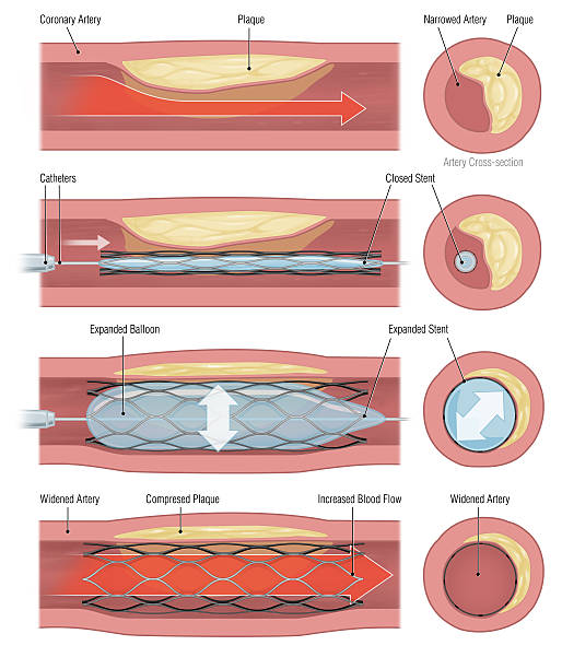 stent - angio stock-grafiken, -clipart, -cartoons und -symbole