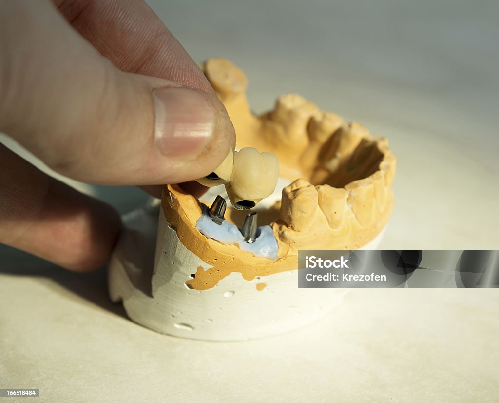 Implantes dentário - Foto de stock de Cerâmica - Artesanato royalty-free