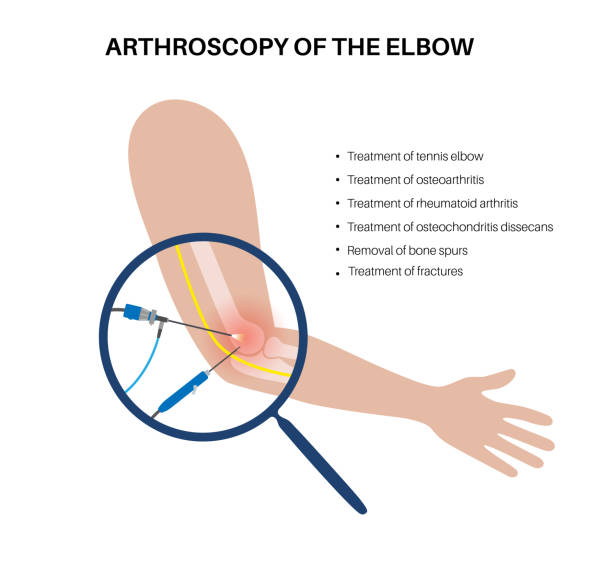 ilustrações de stock, clip art, desenhos animados e ícones de elbow arthroscopy surgery - human arm