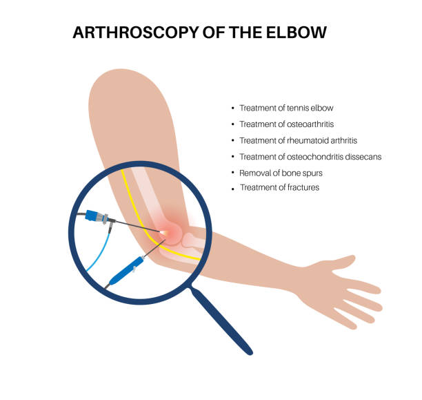 Elbow arthroscopy surgery vector art illustration
