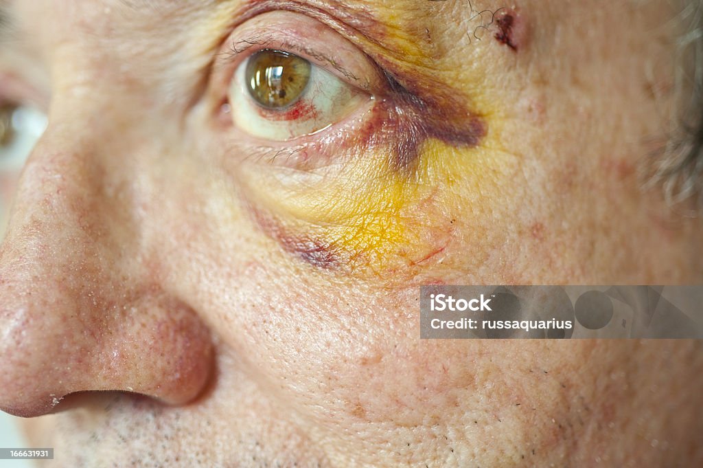 Bruised área de los ojos - Foto de stock de 70-79 años libre de derechos