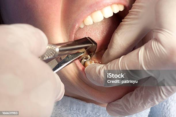 Dentista Foto de stock y más banco de imágenes de Quitar - Quitar, Dientes humanos, Adulto