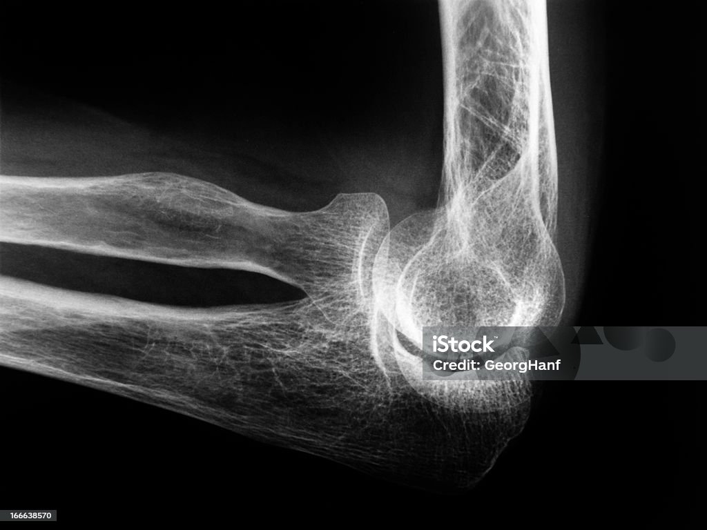 Human Ellenbogen bone - Lizenzfrei Röntgenbild Stock-Foto