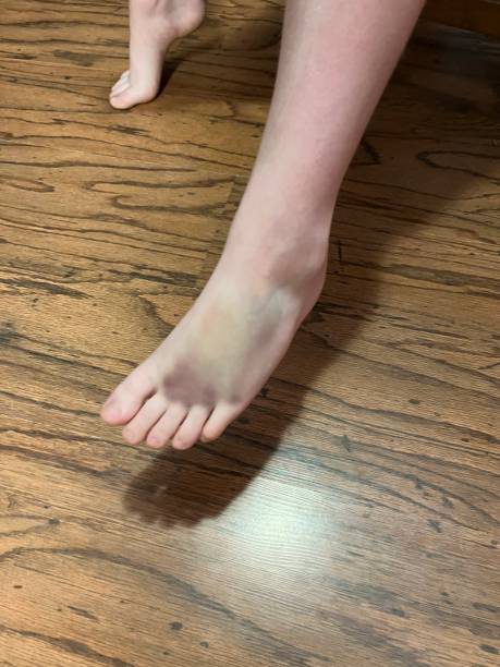 Bruised Foot stock photo