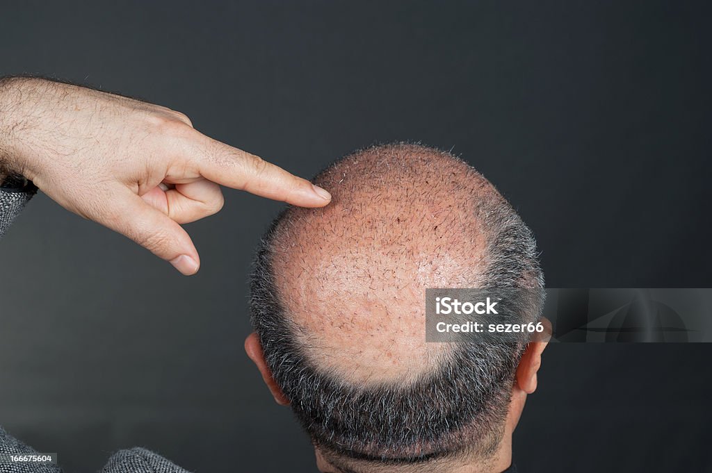 Après Transplantation du cheveux - Photo de Greffe de cheveux libre de droits