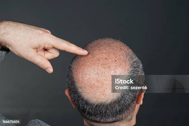 Photo libre de droit de Après Transplantation Du Cheveux banque d'images et plus d'images libres de droit de Greffe de cheveux - Greffe de cheveux, Front, Horizontal