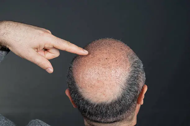 Photo of after hair transplant
