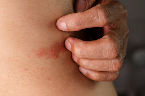 Hombre con enfermedad de culebrilla, piel infectada con herpes zóster, virus, atención médica y médica. photo