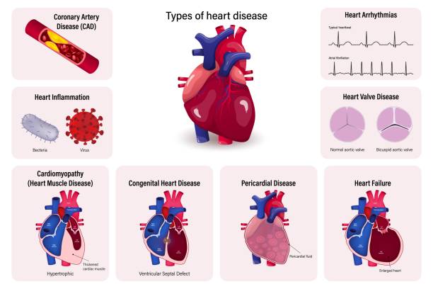 types of heart disease vector. coronary artery
disease (cad), heart inflammation, cardiomyopathy, congenital heart disease, pericarditis, heart failure, heart valve and cardiac arrhythmias. - kalp-krizi stock illustrations