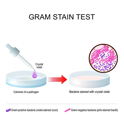 Gram stain test. A glass Petri dish with pathogen bacterial culture before and after use Crystal violet. Bacteria stained with gentian violet. Gram-positive bacteria are violet-stained like cocci. Gram-negative bacteria are pink-stained like bacilli. Vector illustration