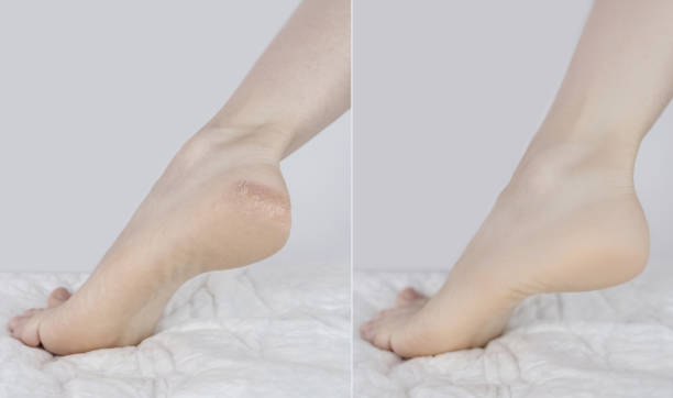 Usage foot grater, cream with urea, softening oil. Cracked heels. Woman feet before and after procedures to soften rough skin. Urea cream, oil for care of keratinized skin, healing of cracked foot. tacones agrietados. pies de mujer antes y después de los procedimientos para suavizar la piel áspera. crema de urea, aceite para el cuidado de la piel queratinizada, curación del pie agrietado. uso rallador de pies, crema con urea, aceite suavizante.