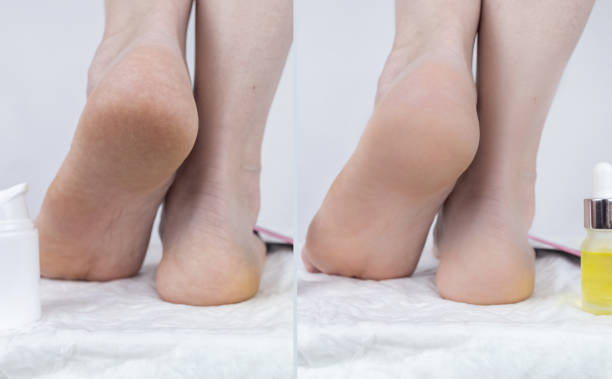 Usage foot grater, cream with urea, softening oil. Cracked heels. Woman feet before and after procedures to soften rough skin. Urea cream, oil for care of keratinized skin, healing of cracked foot. tacones agrietados. pies de mujer antes y después de los procedimientos para suavizar la piel áspera. crema de urea, aceite para el cuidado de la piel queratinizada, curación del pie agrietado. uso rallador de pies, crema con urea, aceite suavizante.