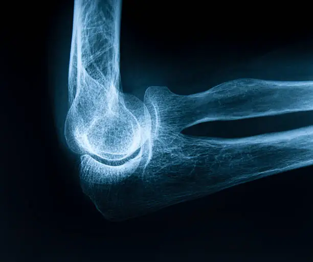 Photo of Human elbow bone
