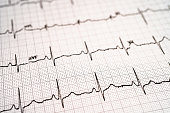Electrocardiogram ECG, heart wave, heart attack, cardiogram report.