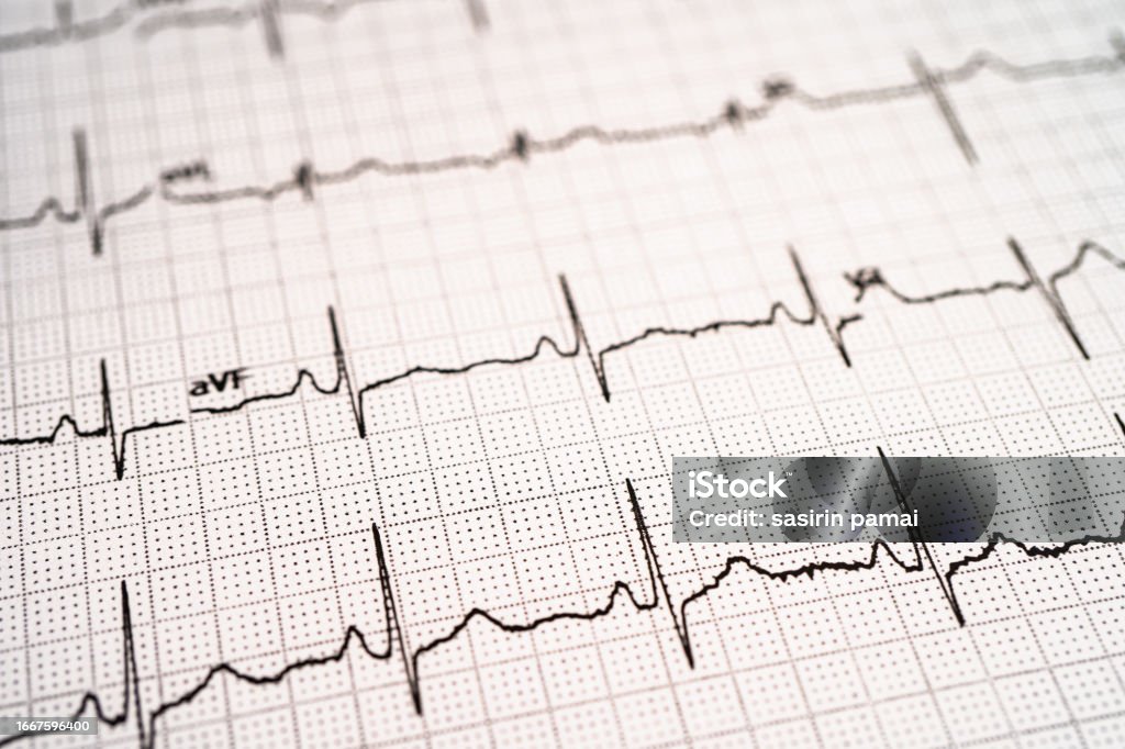 Electrocardiogram ECG, heart wave, heart attack, cardiogram report. Electrocardiography Stock Photo