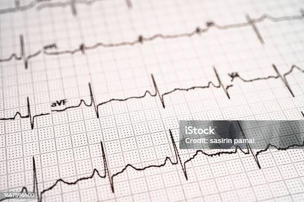 Electrocardiogram Ecg Heart Wave Heart Attack Cardiogram Report Stock Photo - Download Image Now