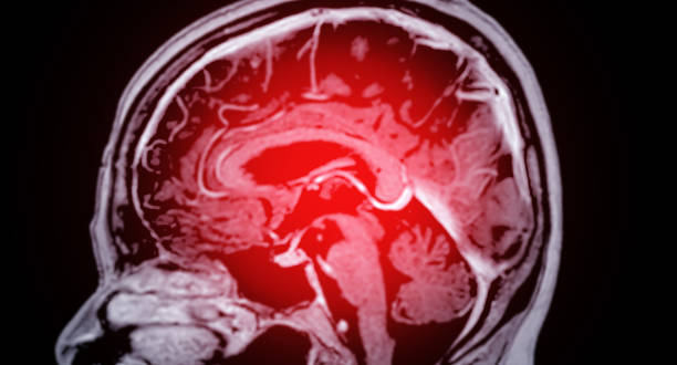 resonancia magnética cerebral para detectar enfermedades cerebrales sush como enfermedad de accidente cerebrovascular, tumores cerebrales e infecciones. - mri scan brain alzheimers disease medical scan fotografías e imágenes de stock