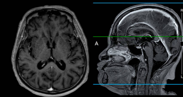 resonancia magnética cerebral vista axial y sagital con línea de referencia para detectar enfermedades cerebrales sush como enfermedad por accidente cerebrovascular, tumores cerebrales e infecciones. - mri scan brain alzheimers disease medical scan fotografías e imágenes de stock