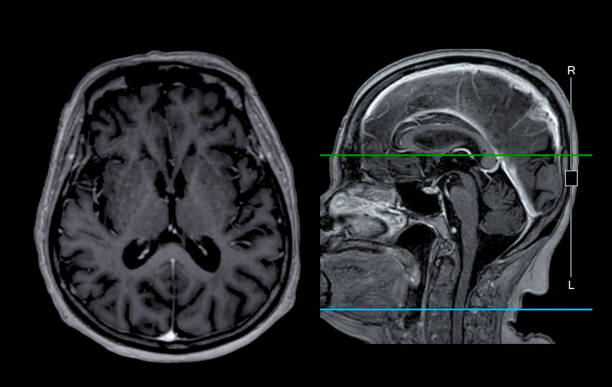 resonancia magnética cerebral vista axial y sagital con línea de referencia para detectar enfermedades cerebrales sush como enfermedad por accidente cerebrovascular, tumores cerebrales e infecciones. - mri scan brain alzheimers disease medical scan fotografías e imágenes de stock