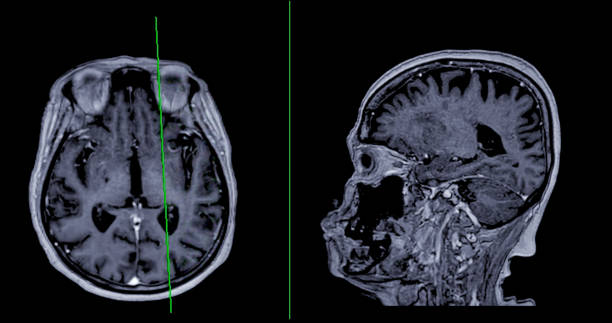istock MRI  brain scan Axial  and sagittal view with reference line for detect  Brain  diseases sush as stroke disease, Brain tumors and Infections. 1667670819