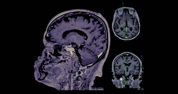 resonancia magn�ética cerebral axial, vista coronal y sagital con línea de referencia para detectar enfermedades cerebrales sush como enfermedad de accidente cerebrovascular, tumores cerebrales e infecciones. - mri scan human nervous system brain medical scan fotografías e imágenes de stock